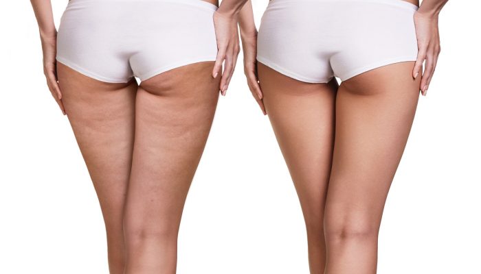 Finally! A Way To Treat Cellulite That Is Non-Invasive And Effective!